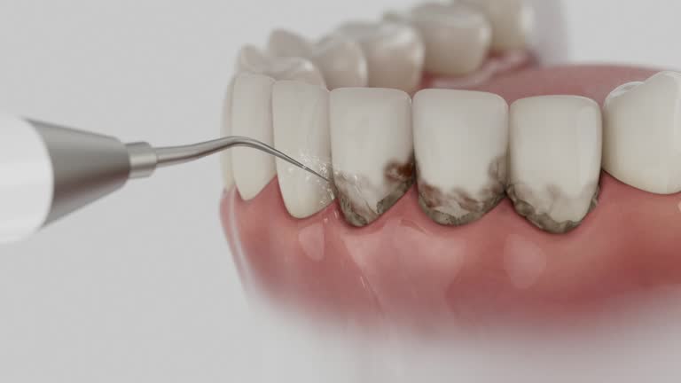 Trusted Teeth Cleaning And Checkup service in North Druid Hills, GA - Dentist Open Now